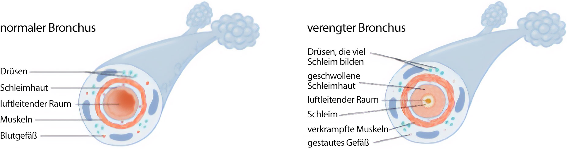 Asthma Bronchiale